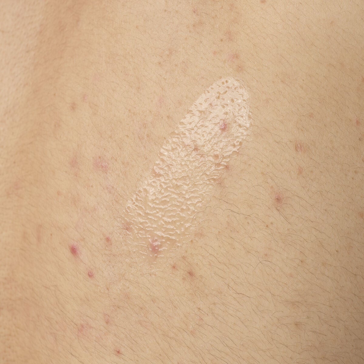 salicylic-acid-0-5-body-serum-p8 ORD-salicylic-acid-05-body-240ml-application.jpg