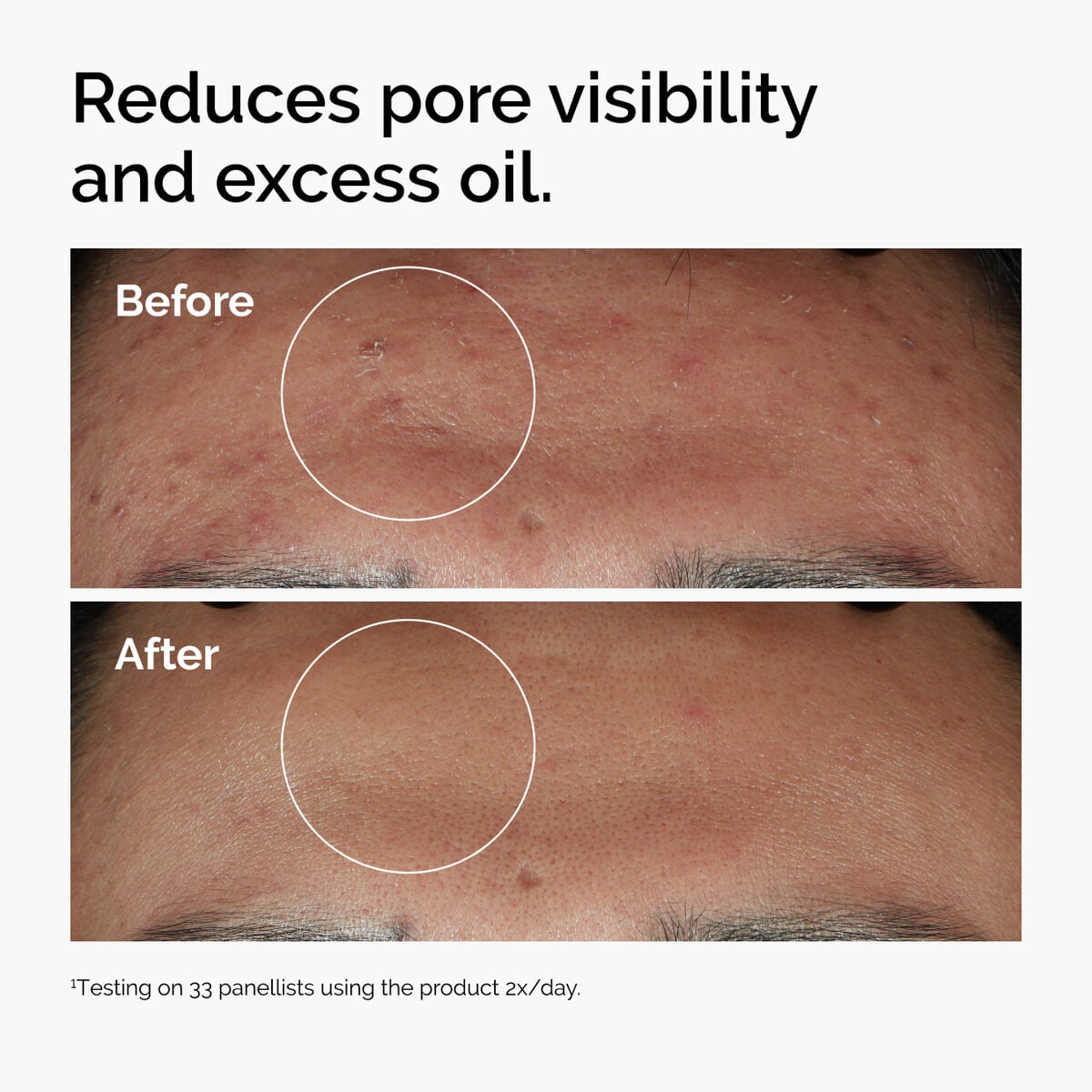 niacinamide-10-zinc-1-g4 ord-niacinamide-zinc-blemish-serum-before-after-pores.jpg