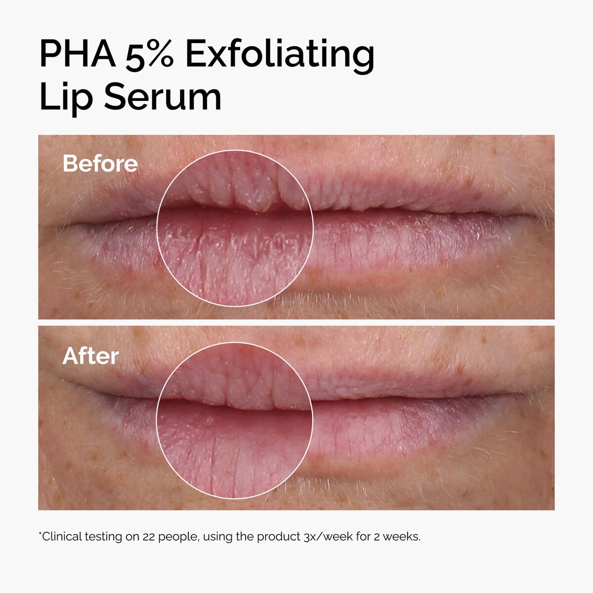 pha-5-exfoliating-lip-serum-x4 ord-pha-5pct-lip-exfoliating-serum-before-after.jpg