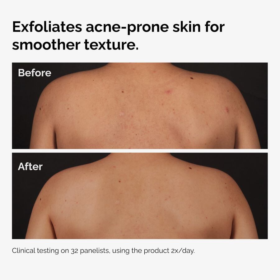 the-body-care-collection-c3 ord-salicylic-acid-body-serum-before-after-graphic-NA.jpg