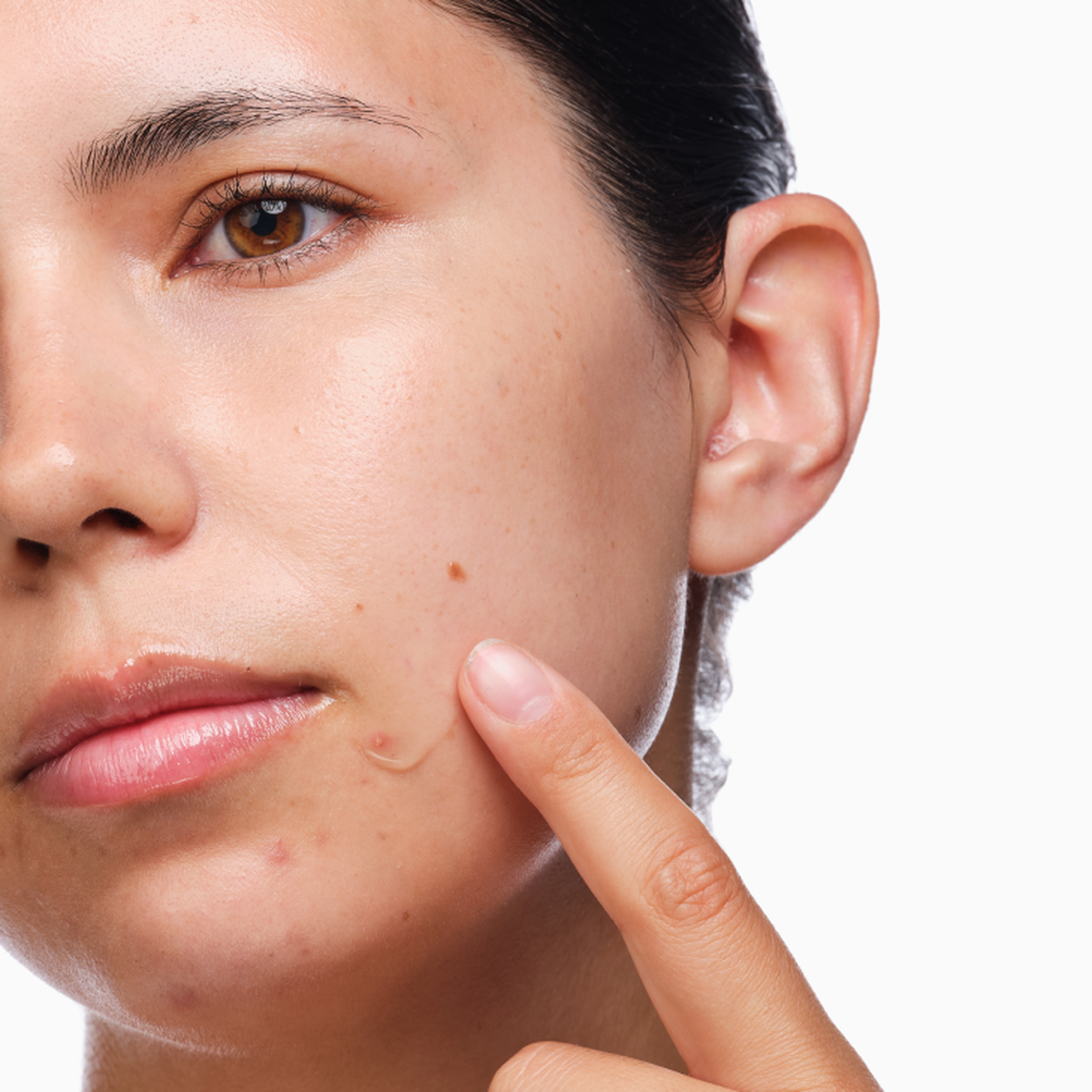 the-acne-set-s0 rdn-the-acne-set-application.png